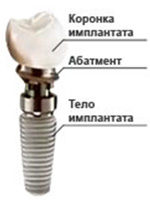 Строение имплантата