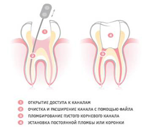 Лечение каналов